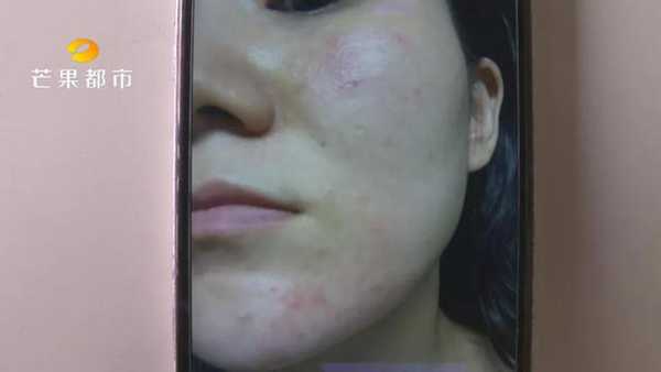 芜湖苗方清颜怎么样（苗方清颜如何祛痘印）