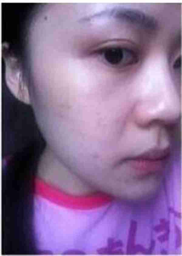 换季长痘痘 看他是怎么有效的祛除多年的痘痘