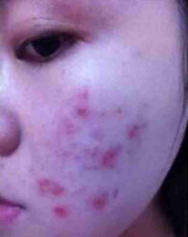 换季长痘痘 看他是怎么有效的祛除多年的痘痘