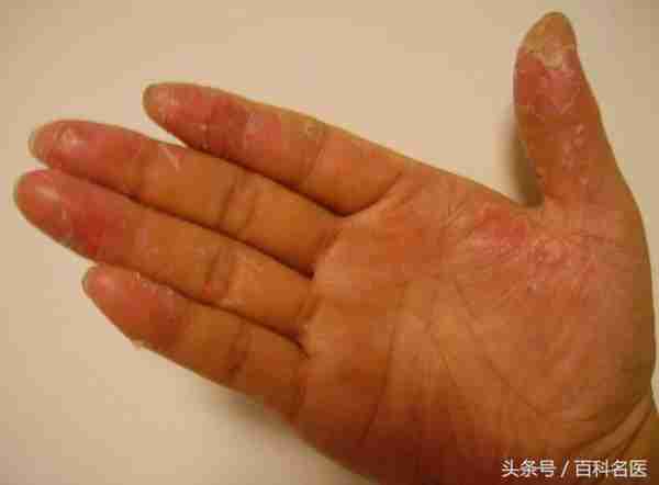 一换季手就脱皮是怎么回事儿?有什么方法可以根治吗?送你几个小偏方!