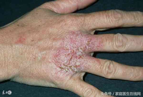 湿疹用什么药膏最有效(最靠谱方案推荐)