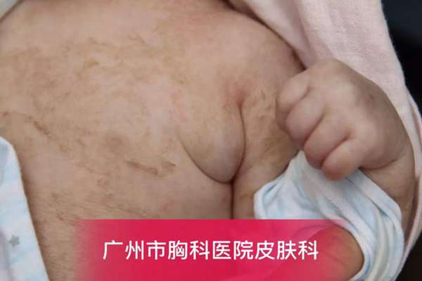 卡介苗接种后，父母需要注意什么？