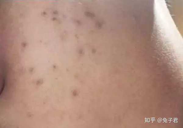 脸上痘印总不掉？教你3步祛除痘印！