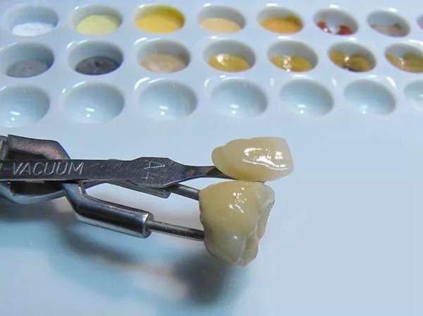 种植牙到底是什么?今天就来扒扒它!