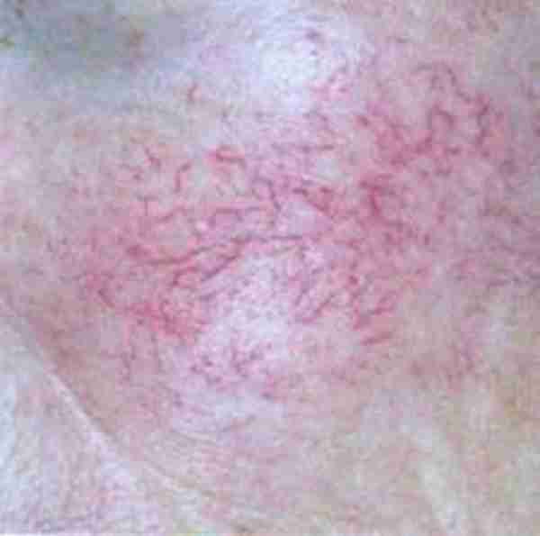 什么是红血丝皮肤(脸部红血丝是由什么原因引起的呢)