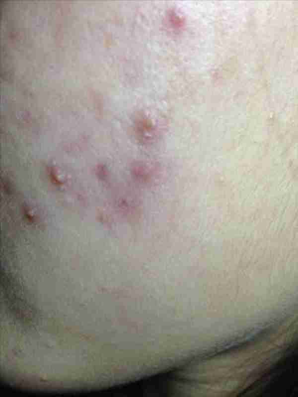 皮肤出现红血丝的原因是什么?怎么护理?