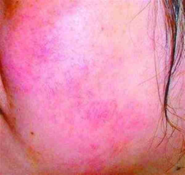 皮肤出现红血丝的原因是什么?怎么护理?