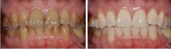 四环素这个名字不太熟悉,到底四环素牙怎么来的?