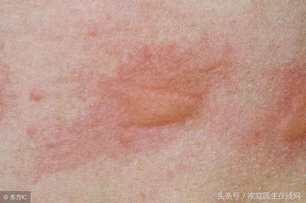 什么是荨麻疹（荨麻疹有哪些症状）