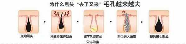 去除黑头的六种方法，到底哪种最有效？