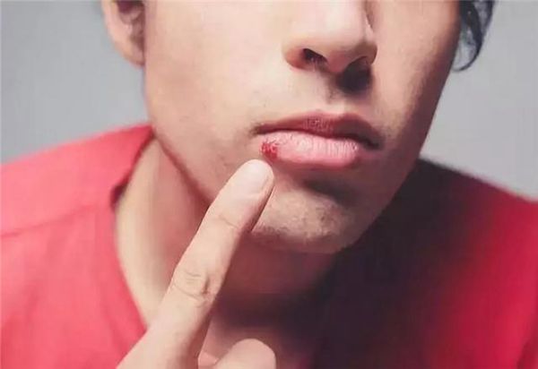 嘴角烂是什么原因(帮您从根本上解决问题)