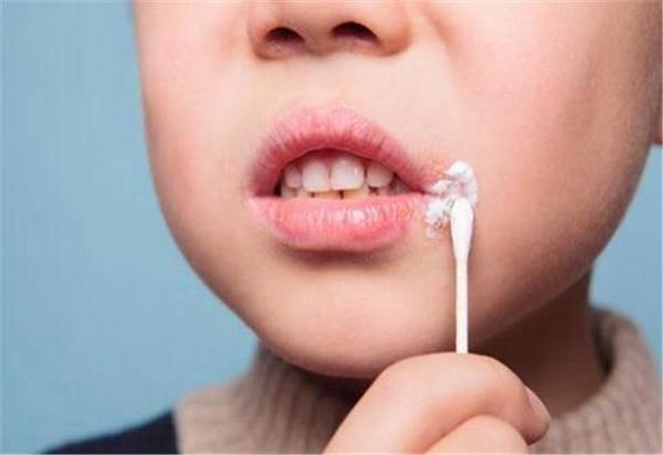 为啥到了秋冬季嘴角总溃烂,真的是上火了吗?听听教授怎么说