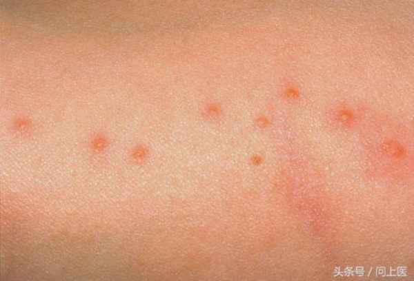 怎么消灭床上的可恶臭虫?