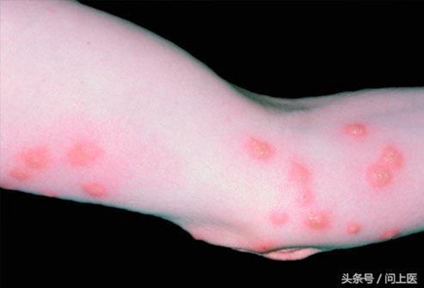 怎么消灭床上的可恶臭虫?