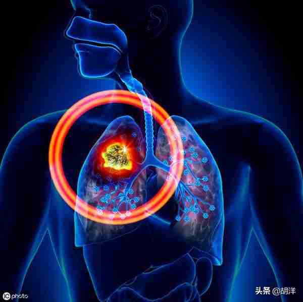 什么样的症状提示肺癌,医生列出7点,每一点都可能是肺癌征兆