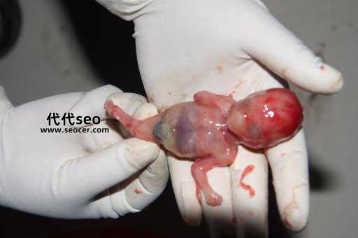 人流引产是什么意思（什么情况下会进行引产手术）