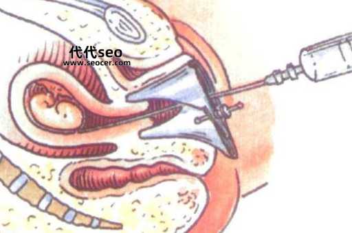 人流引产是什么意思（什么情况下会进行引产手术）