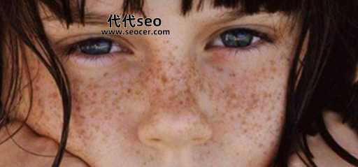 雀斑是怎么淡化(小孩雀斑最佳去掉时间)