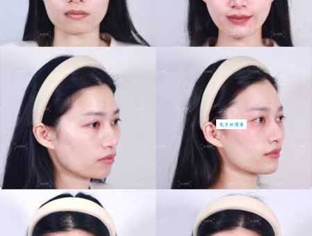 美人三分龅：凸嘴是美是丑？网友热议不断